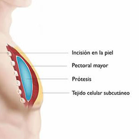 Implantes Pectorales Pectoral Mayor